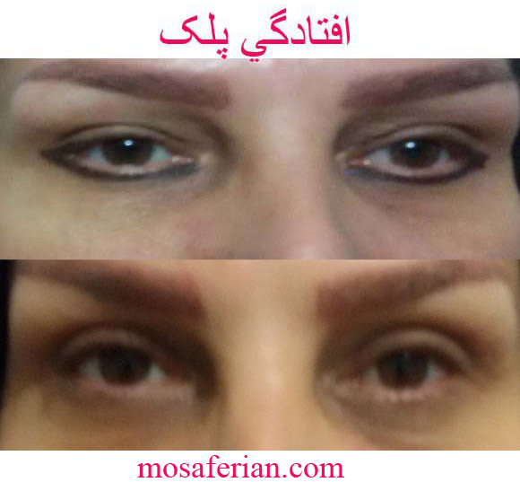 جراحی پلک+هزینه