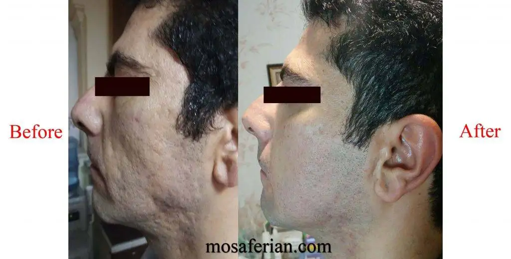 ندبات حب الشباب