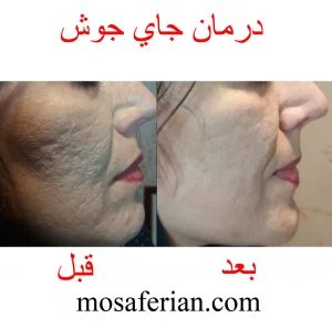 علاج ندبات حب الشباب