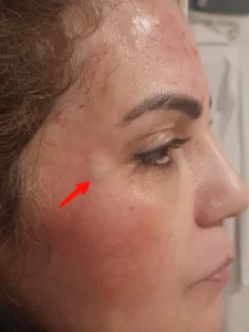 كدمات بعد مادة البوتوكس