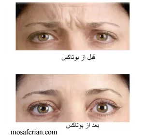 حقن البوتکس قبل وبعد