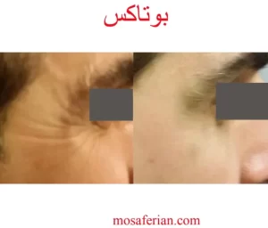 حقن البوتکس قبل وبعد