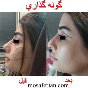 حقن الجوفيديرم قبل و بعد