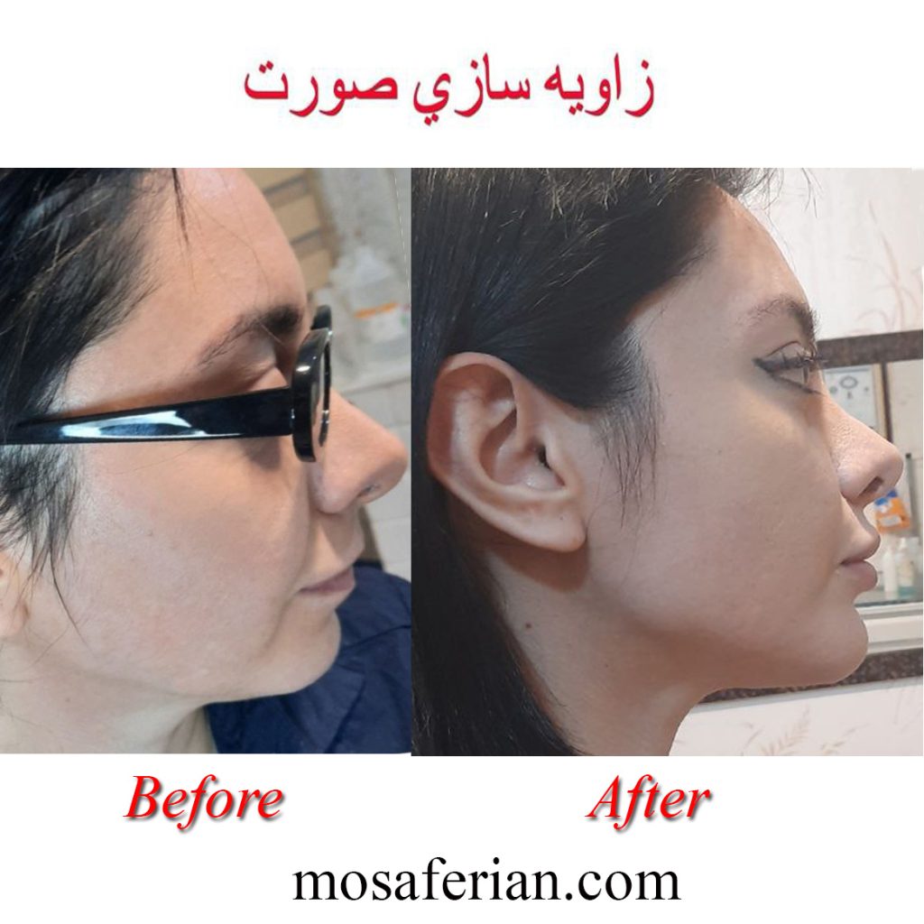 احسن انواع الفيلر