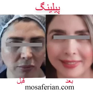 التقشير الكيميائي للوجه قبل و بعد