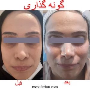 حقن الفيلر تحت العين قبل و بعد