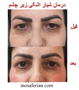 حقن الفیلر تحت العین