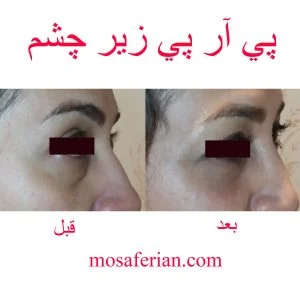 بلازما تحت العین
