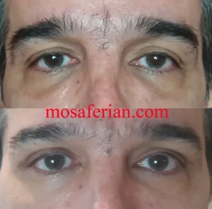 نانوفات تحت العین