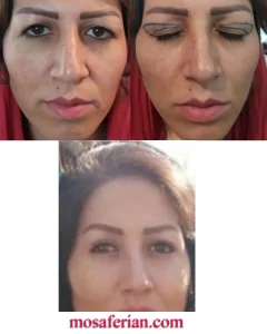 عملية شد الجفون بالصور
