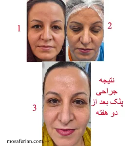 شكل العين بعد عملية شد الجفون