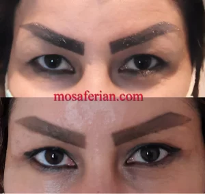 عملية شد الجفون العلوية