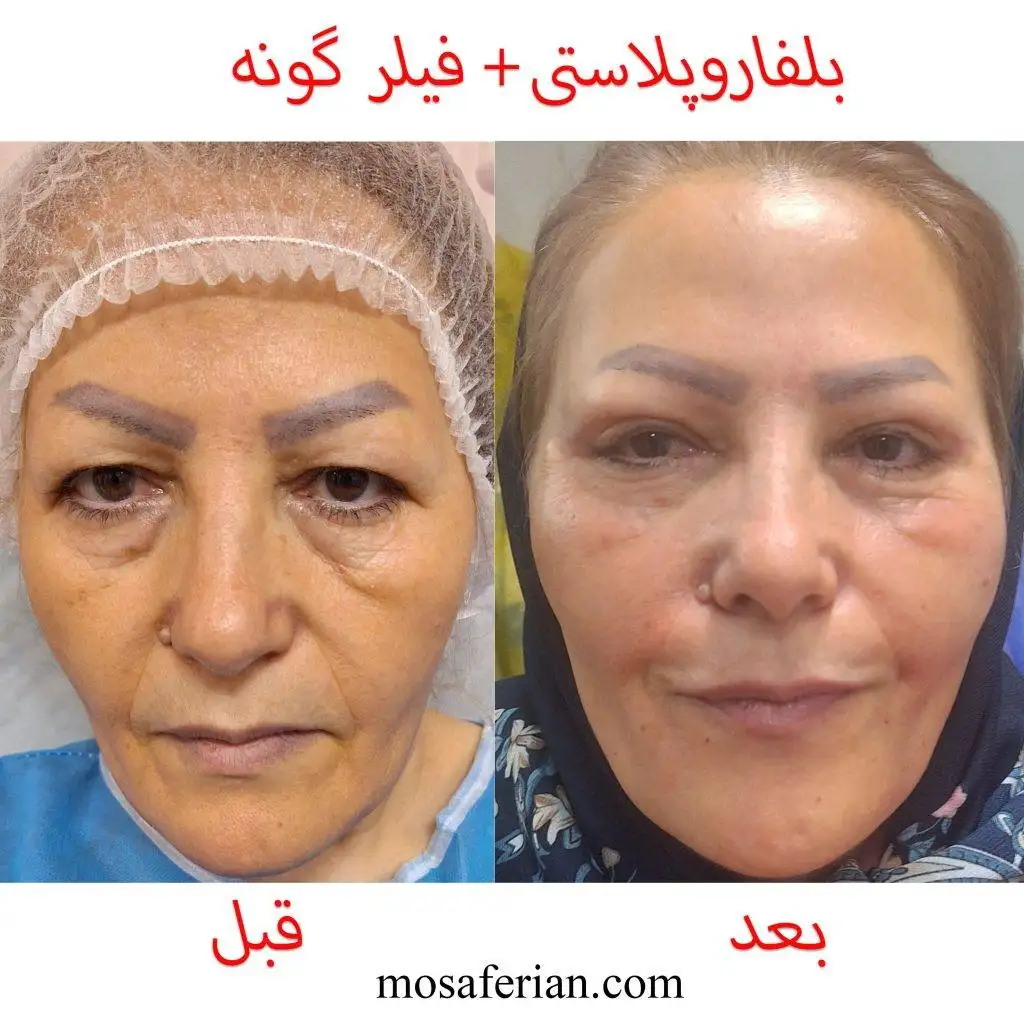 حقن الفلر