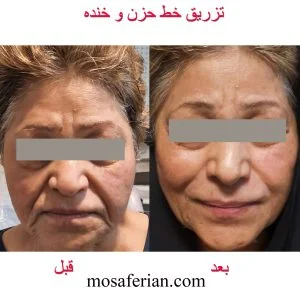 حقن فيلر الخدود قبل وبعد