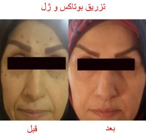الخدود بالفيلر فيلر قبل وبعد