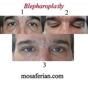 تجميل الجفون قبل وبعد للرجال