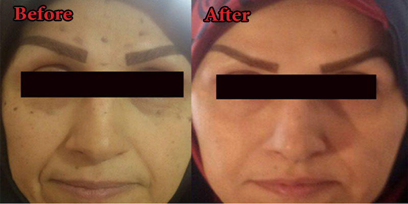 ❤Secret Of Botox Cosmetic In 2023