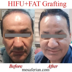 before and after fat grafting and shin tightening