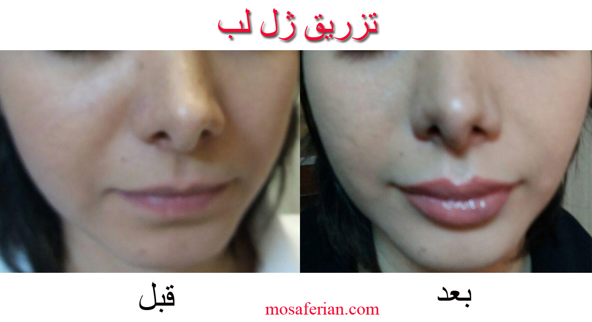 Lip Augmentation Before And After Photos👄