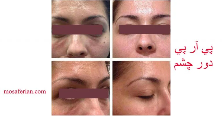 PRP FACIAL BEFORE AND AFTER PHOTOS IN 2023