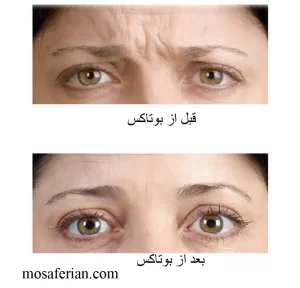 before and after botox