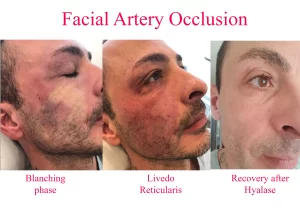 before & after vascular occlusion treated with hyaluronidase