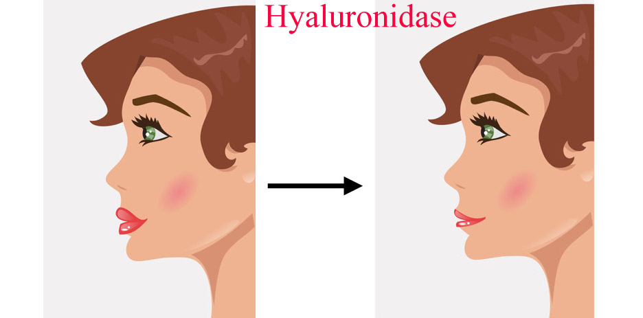 hyaluronidase before and after