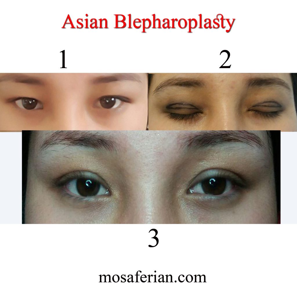 asian blepharoplasty