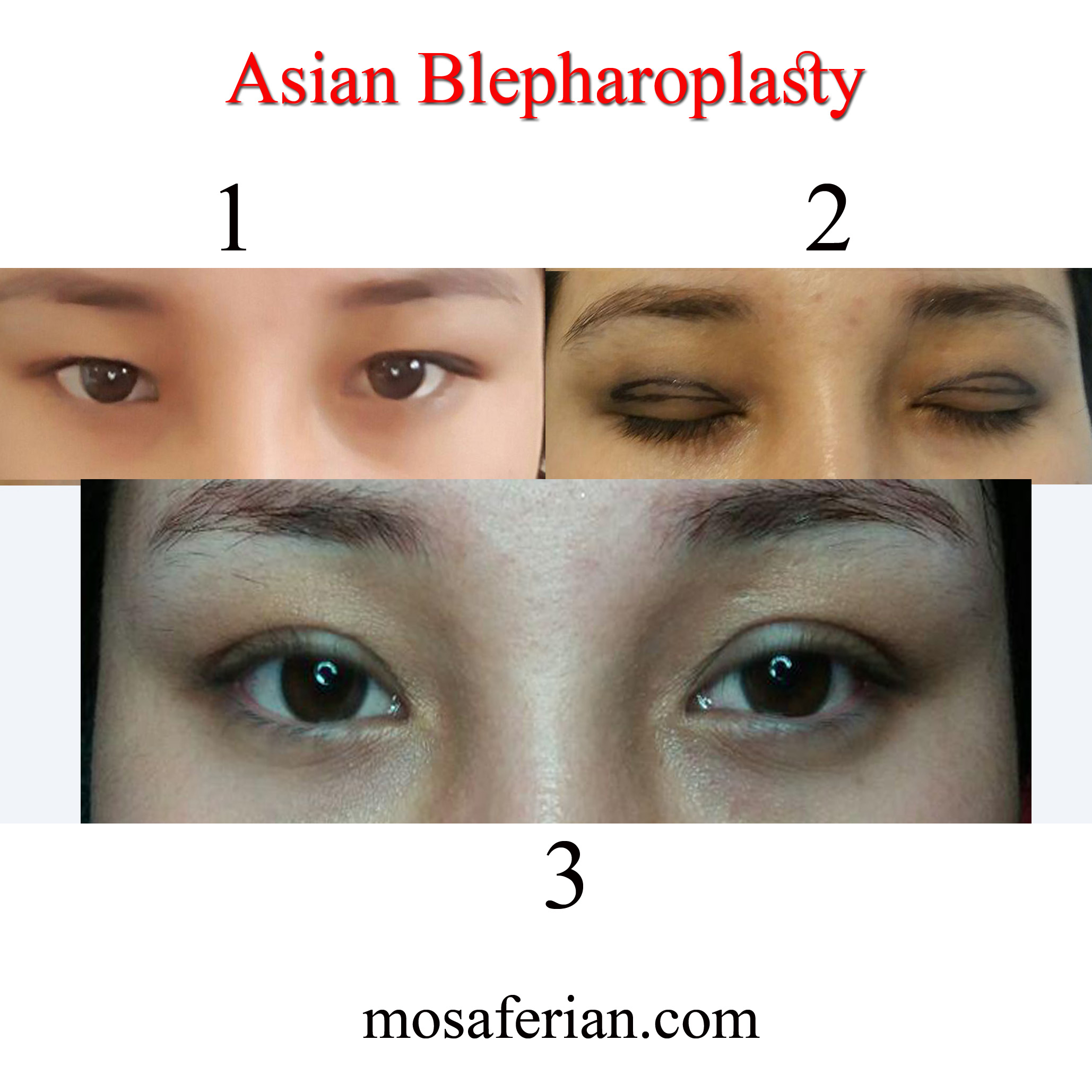 Asian blepharoplasty before and after photos in 2024