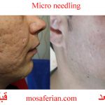 microneedling before after