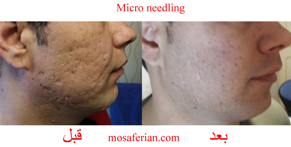 acne scar treatment before after