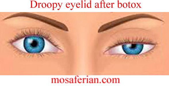 botox side effects droopy eyelid pictures
