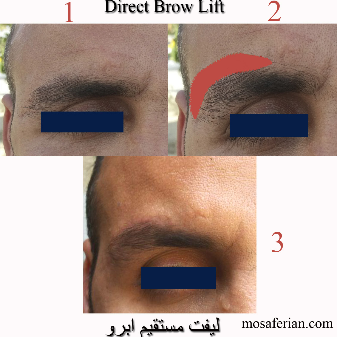 Mini brow lift before and after photos