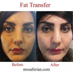 before and after photo of fat grafting to the midface