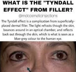 skin color change after hyaluronic acid application in the eyelid
