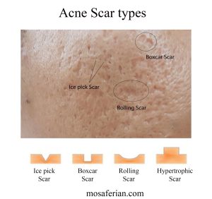 Acne scars treatment