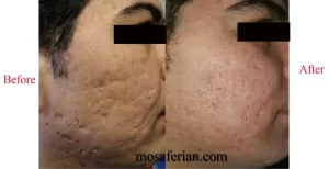 acne scar treatment with meso needling technique before and after