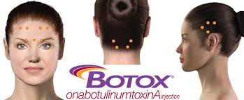 Botox for migraine