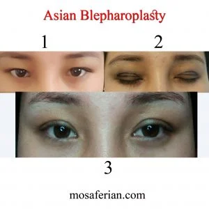 asian eyelid recovery stages