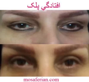 eyelid surgery before and after