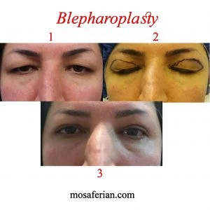 blepharoplasty recovery before and after