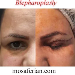 eyelid surgery scar before and after