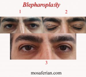male blepharoplasty recovery before and after