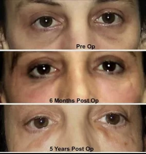 fat transfer to face gone wrong