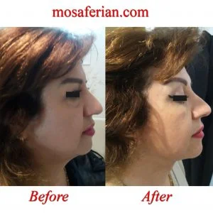 cheek augmentation and double chin lipo