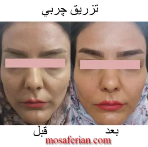 before and after images of nasojugal groove correction