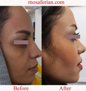  before and after lateral eyebrow elevation