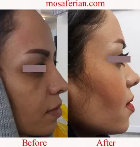 before and after lateral eyebrow elevation