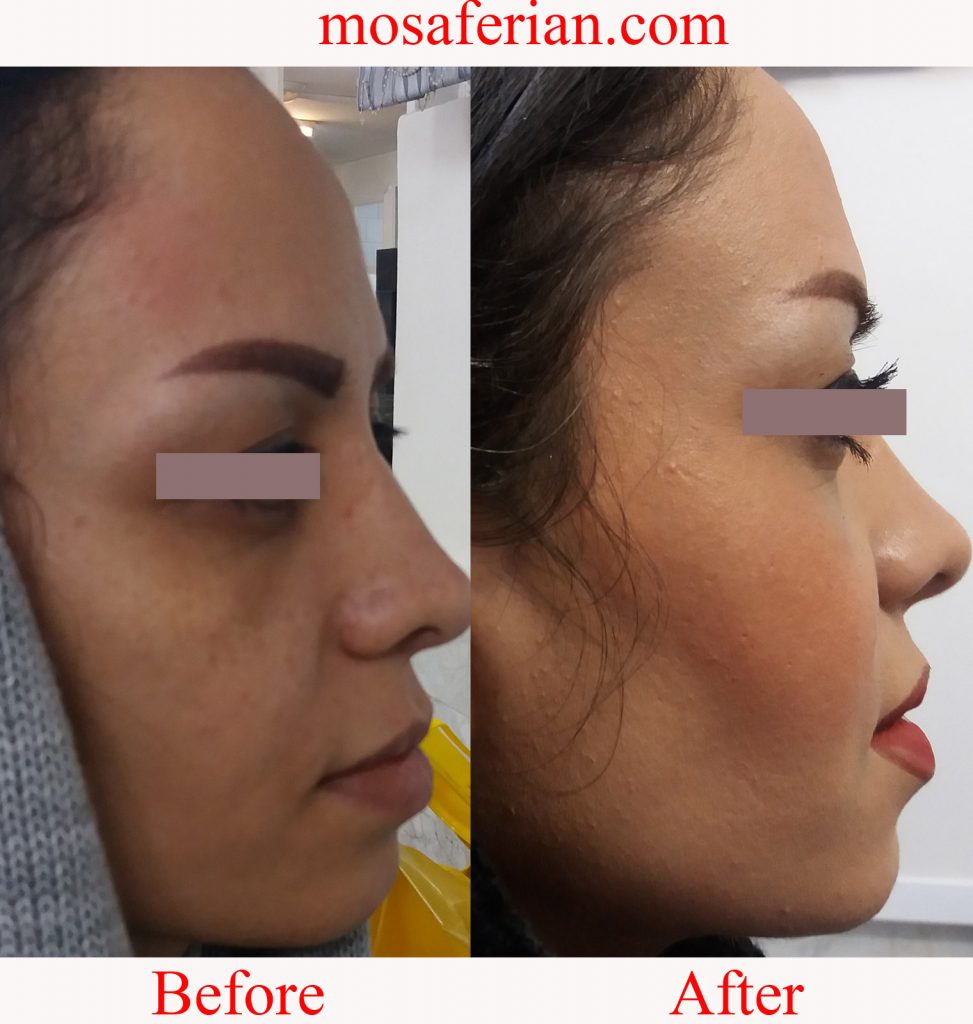 Brow lift scars