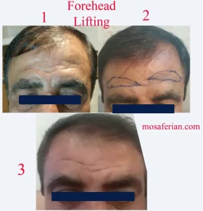 mid forehead approach before and after